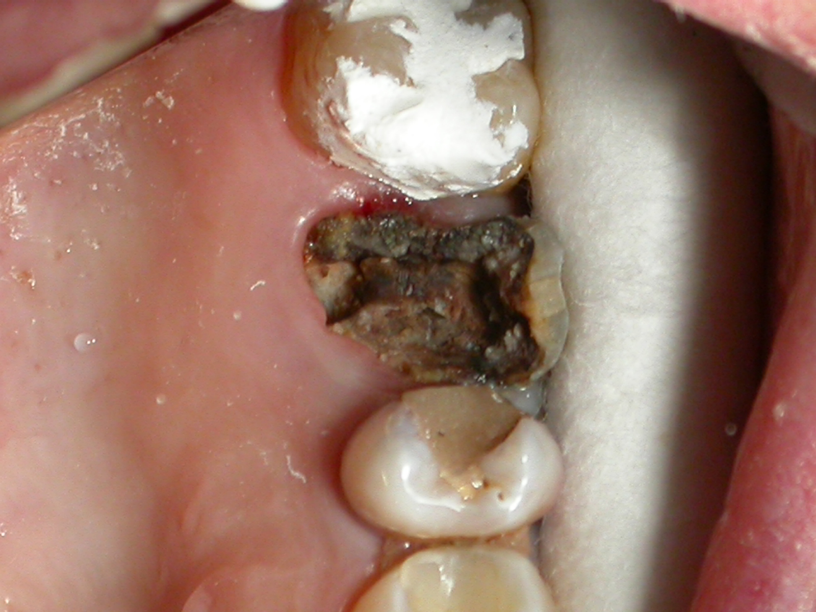 Разрушенные зубы